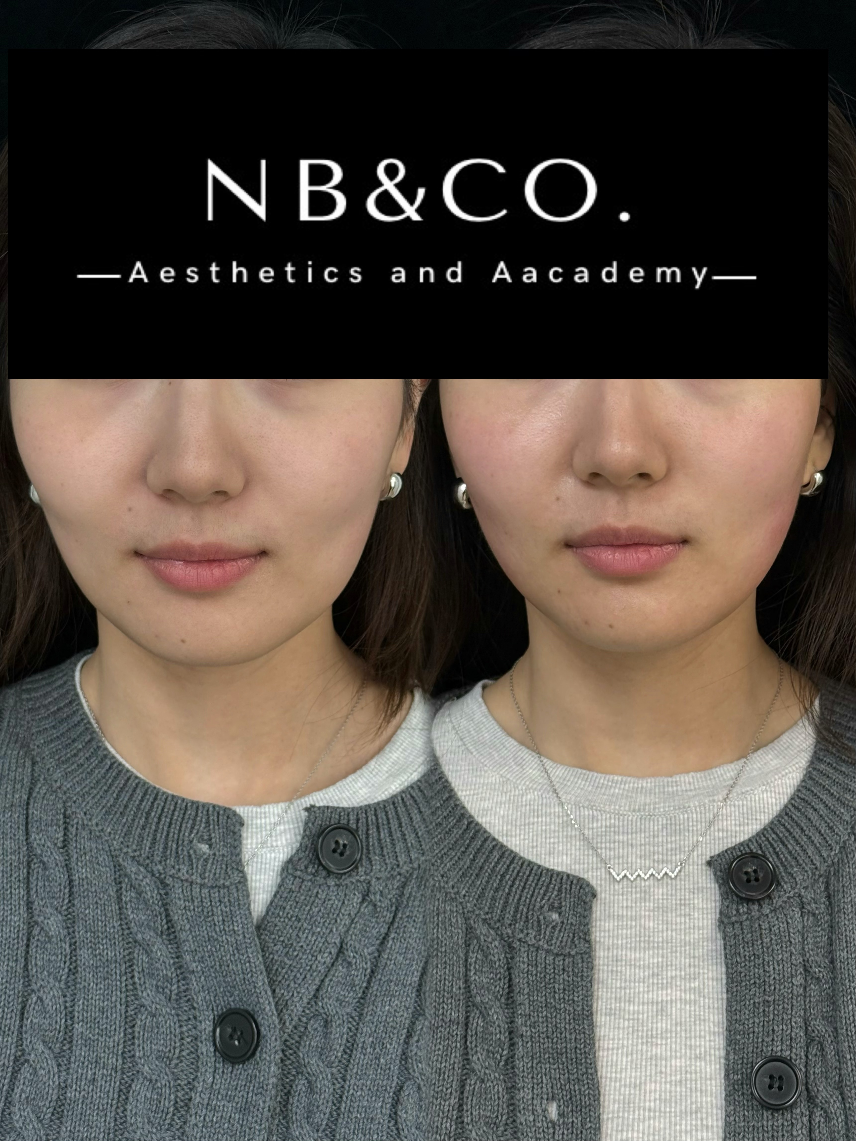 Forma before and after skin tightening result Melbourne